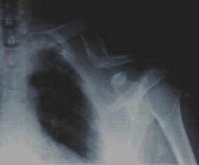 My Broken Left Collarbone....